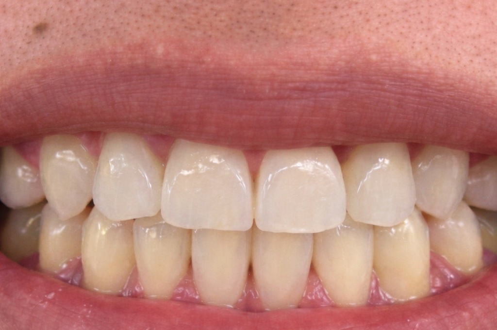 After Smile Transformation - U Dental Clinic