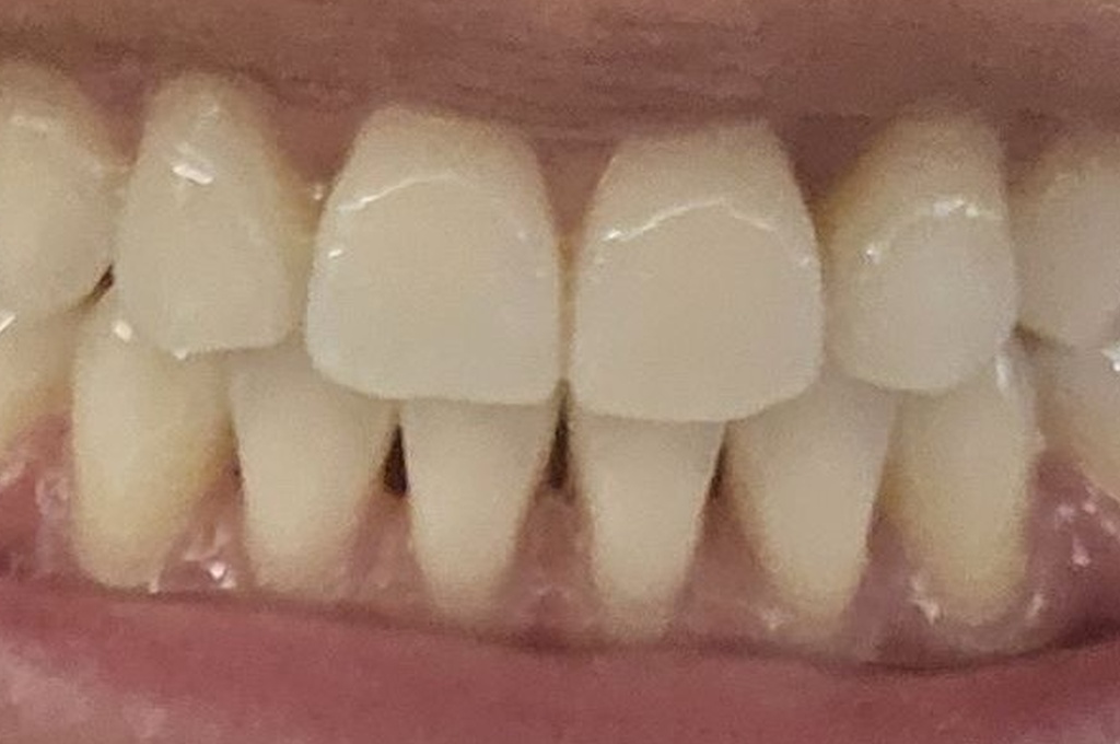 Before Dental Treatment - U Dental Clinic