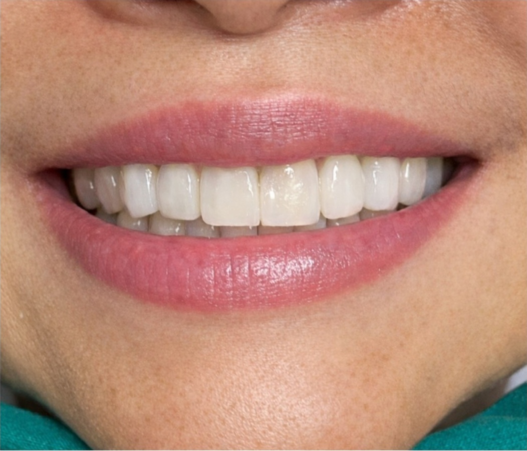 ผลลัพธ์คอมโพสิทวีเนียร์แบบฉีด U Dental Clinic